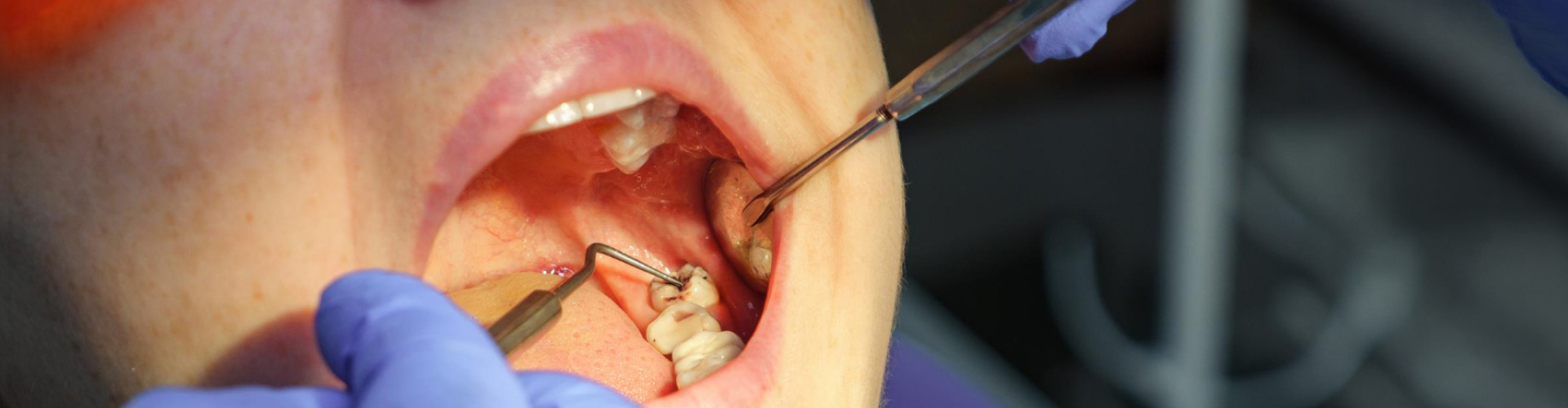 Close-up of a dentist preparing a lower molar for a cavity filling during a restorative dental procedure.